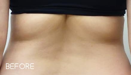 クールスカルプティング®の症例写真 Before