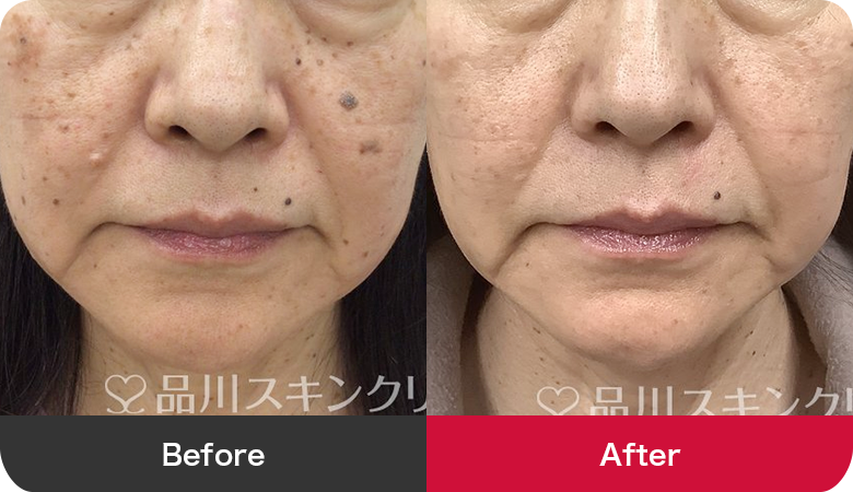 シミ取り治療の症例写真【画像】