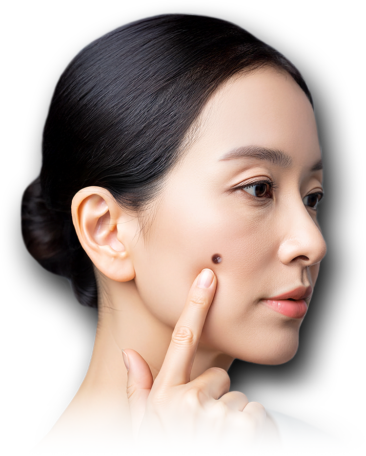 いぼ・ほくろ取りレーザーこんな方におススメ