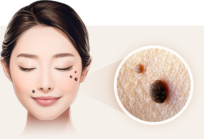 ほくろ（黒子）