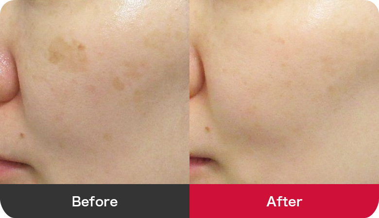 シミ取り治療の症例写真【画像】