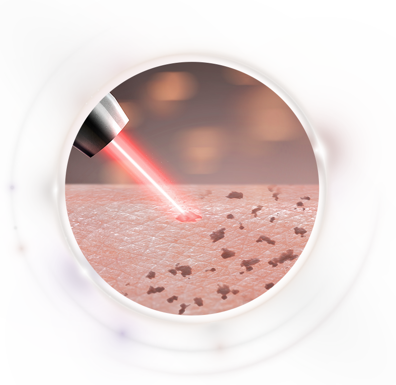 シミ取り治療こんな方におススメ