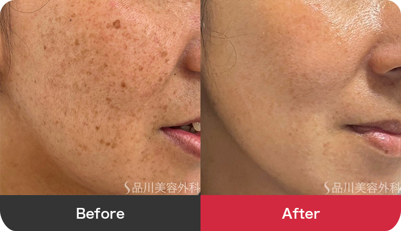 フォトシルクプラス 症例写真【画像】