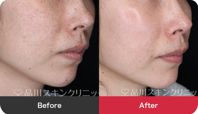 フォトシルクプラス 症例写真【画像】