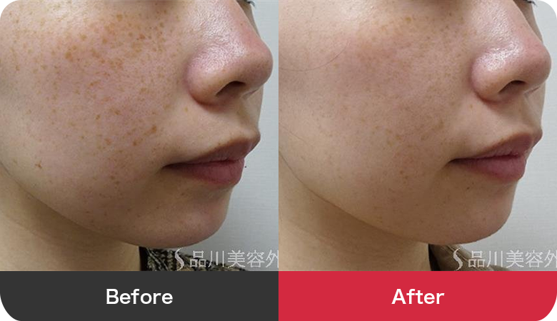 フォトシルクプラス 症例写真【画像】