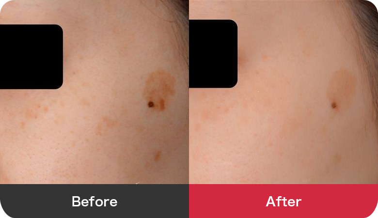 フォトシルクプラス 症例写真【画像】