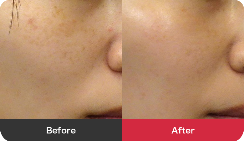 フォトシルクプラス 症例写真【画像】