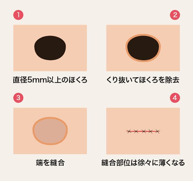 切開による除去【画像】