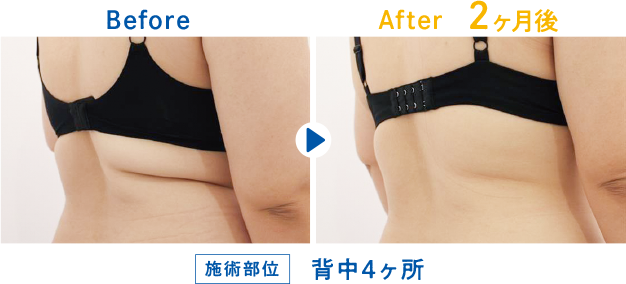 クールスカルプティング 背中と腰まわりの症例